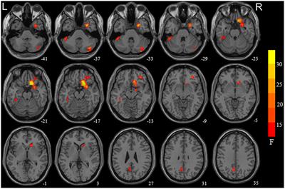 Sex-Dependent Alterations of Regional Homogeneity in Cigarette Smokers